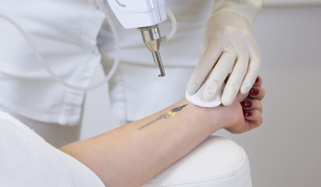 Bezpieczne laserowe usuwanie tatuażu – Laser Pikosekundowy w działaniu